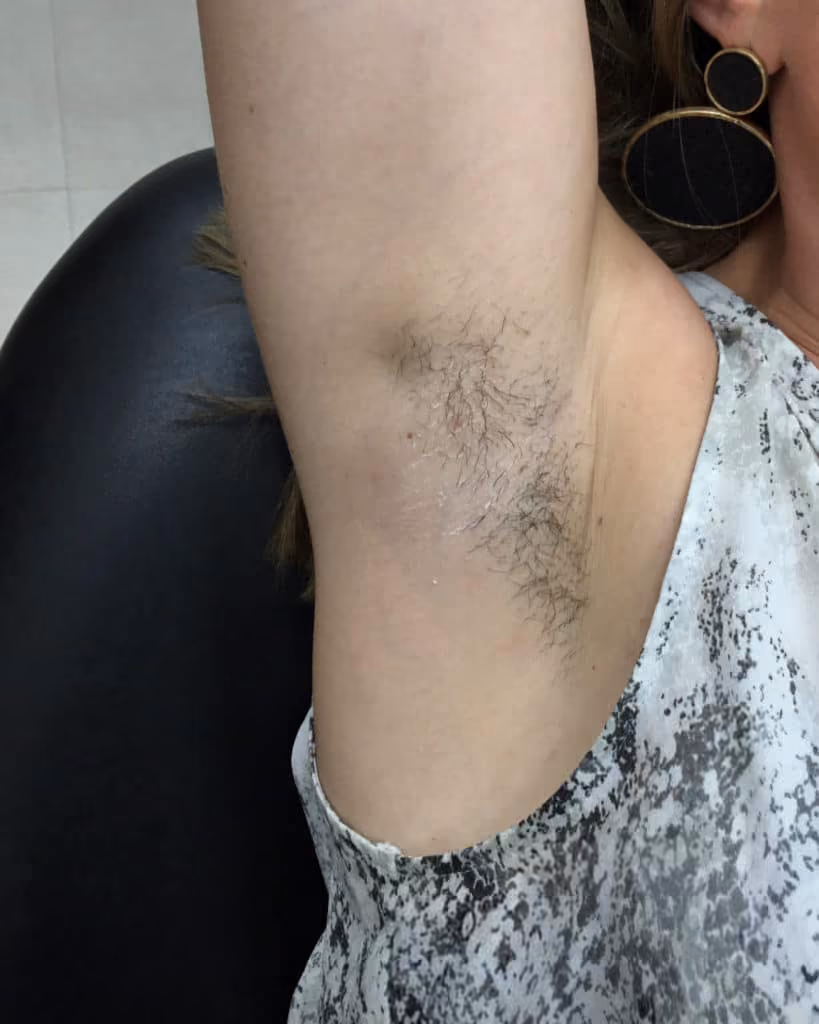 Laser Hair Reduction before and after, case 14695 - Cool Springs Plastic Surgery