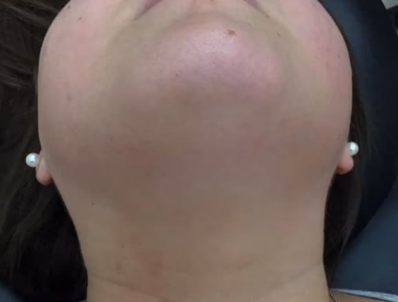 Laser Hair Reduction before and after, case 16557 - Cool Springs Plastic Surgery