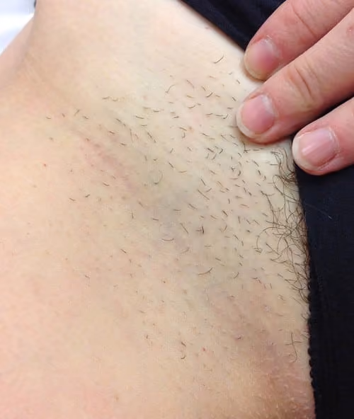 Laser Hair Reduction before and after, case 4430 - Cool Springs Plastic Surgery