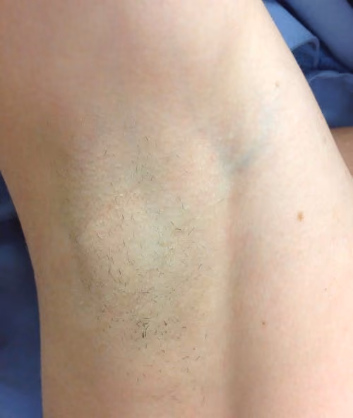Laser Hair Reduction before and after, case 4434 - Cool Springs Plastic Surgery