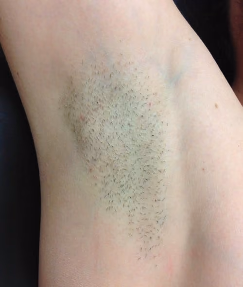 Laser Hair Reduction before and after, case 4434 - Cool Springs Plastic Surgery
