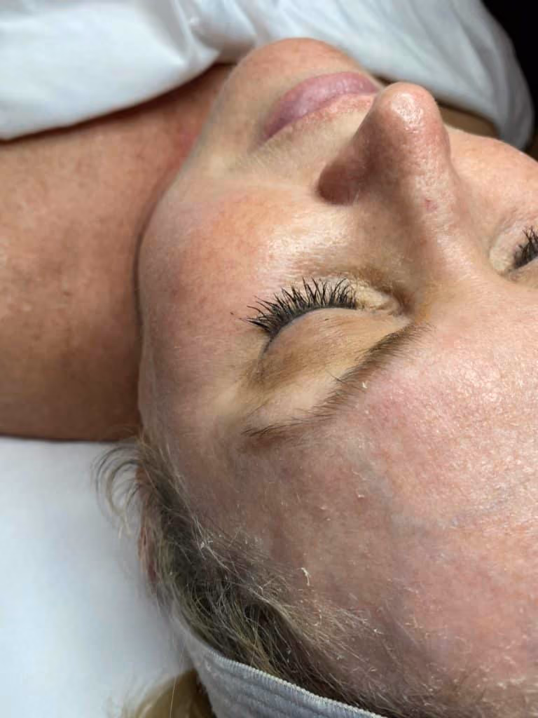 Dermaplaning before and after, case 16924 - Cool Springs Plastic Surgery