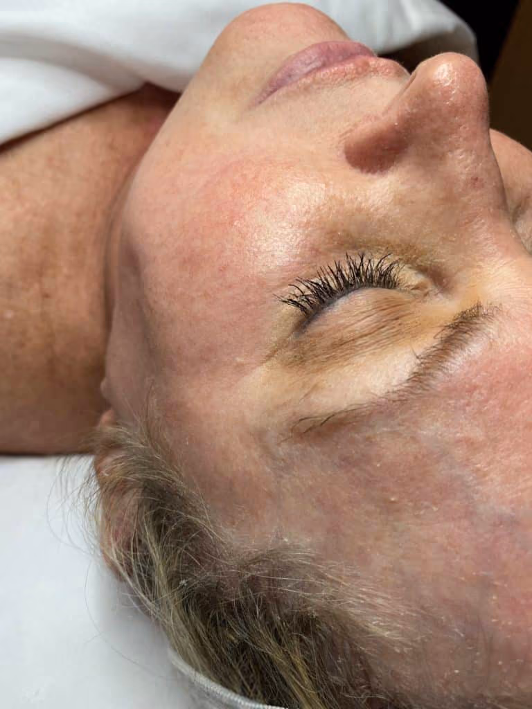 Dermaplaning before and after, case 16924 - Cool Springs Plastic Surgery
