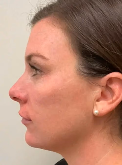 Filler before and after, case 11546-2 - Cool Springs Plastic Surgery