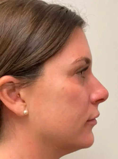 Filler before and after, case 11546-2 - Cool Springs Plastic Surgery