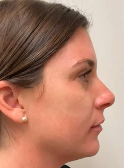 Filler before and after, case 11546-2 - Cool Springs Plastic Surgery