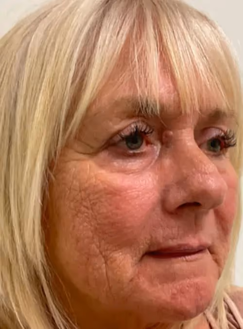 Filler before and after, case 11606 - Cool Springs Plastic Surgery