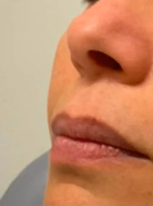 Filler before and after, case 11617 - Cool Springs Plastic Surgery