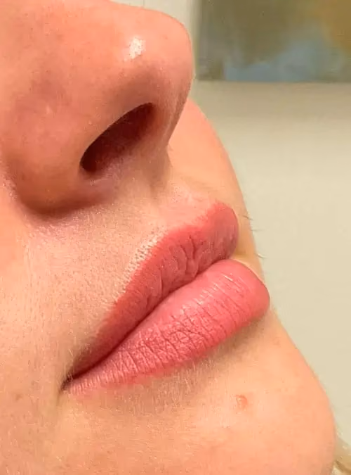 Filler before and after, case 11648 - Cool Springs Plastic Surgery