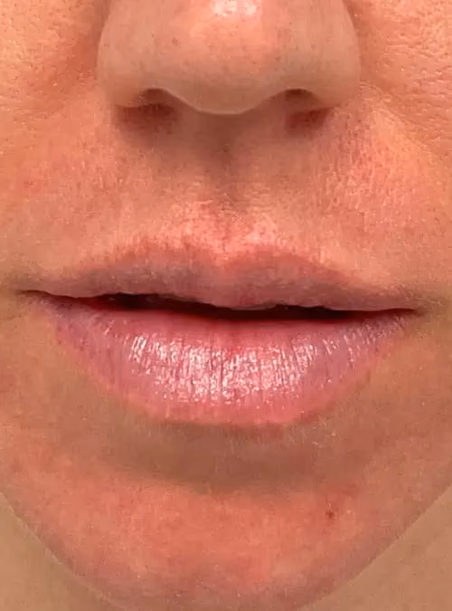 Filler before and after, case 11662 - Cool Springs Plastic Surgery