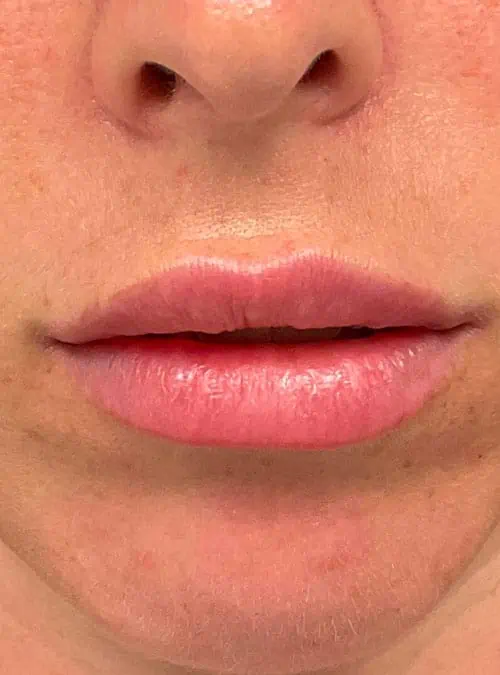 Filler before and after, case 11673 - Cool Springs Plastic Surgery