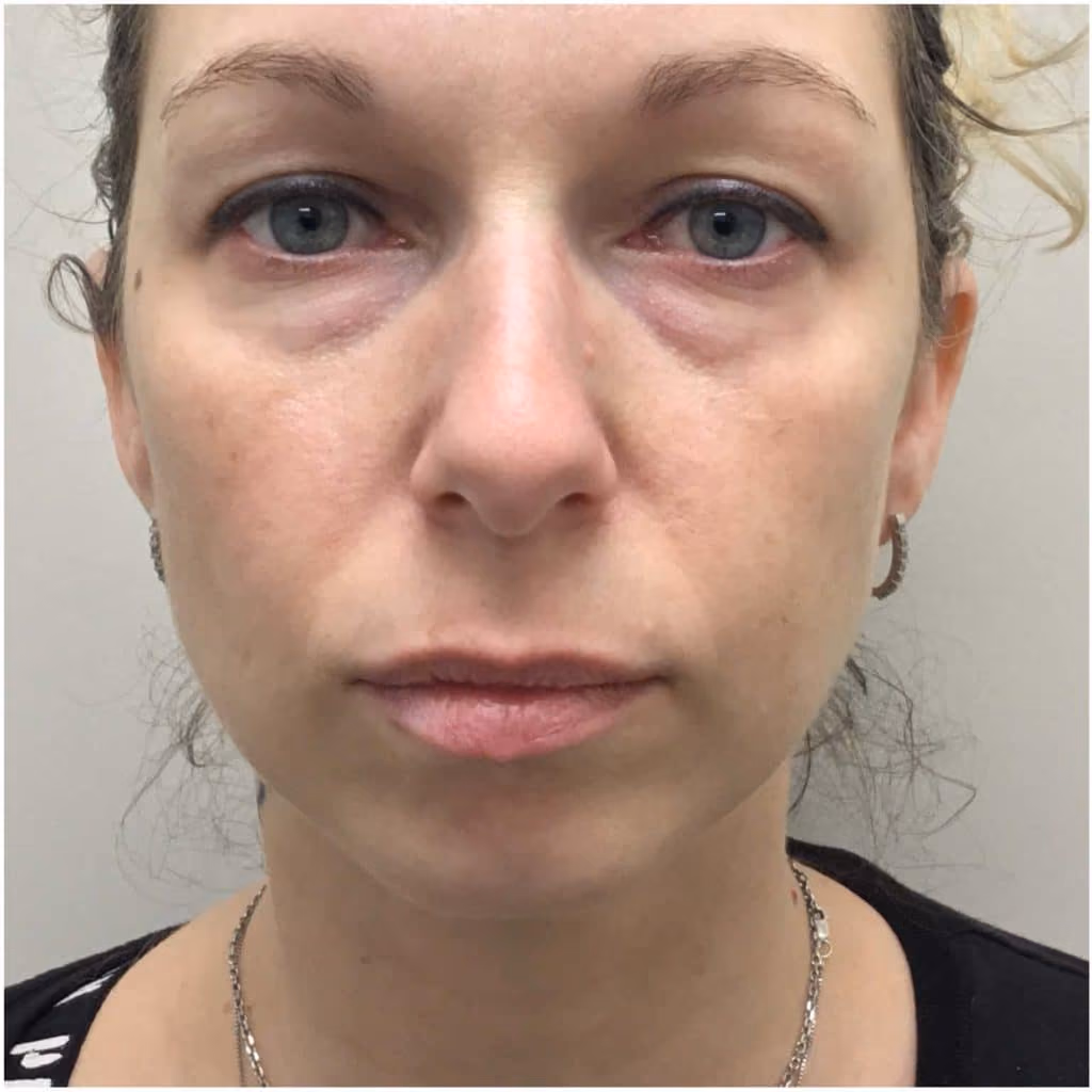 Filler before and after, case 11922 - Cool Springs Plastic Surgery