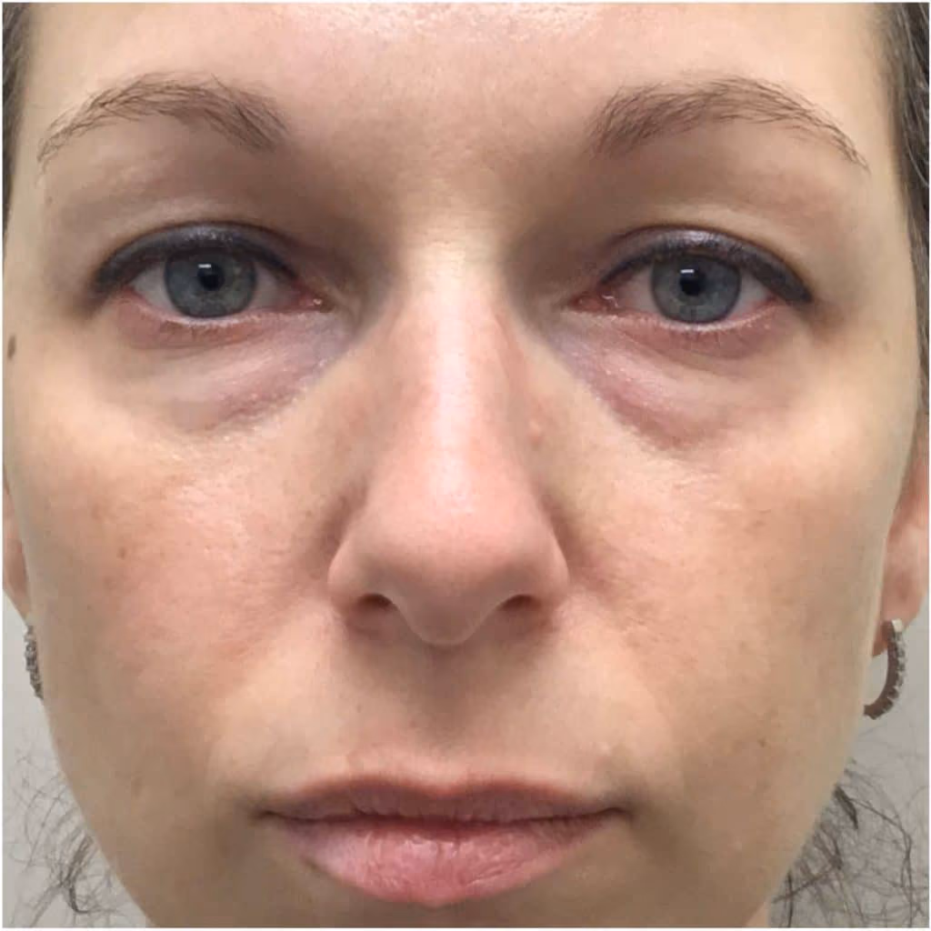 Filler before and after, case 11922 - Cool Springs Plastic Surgery