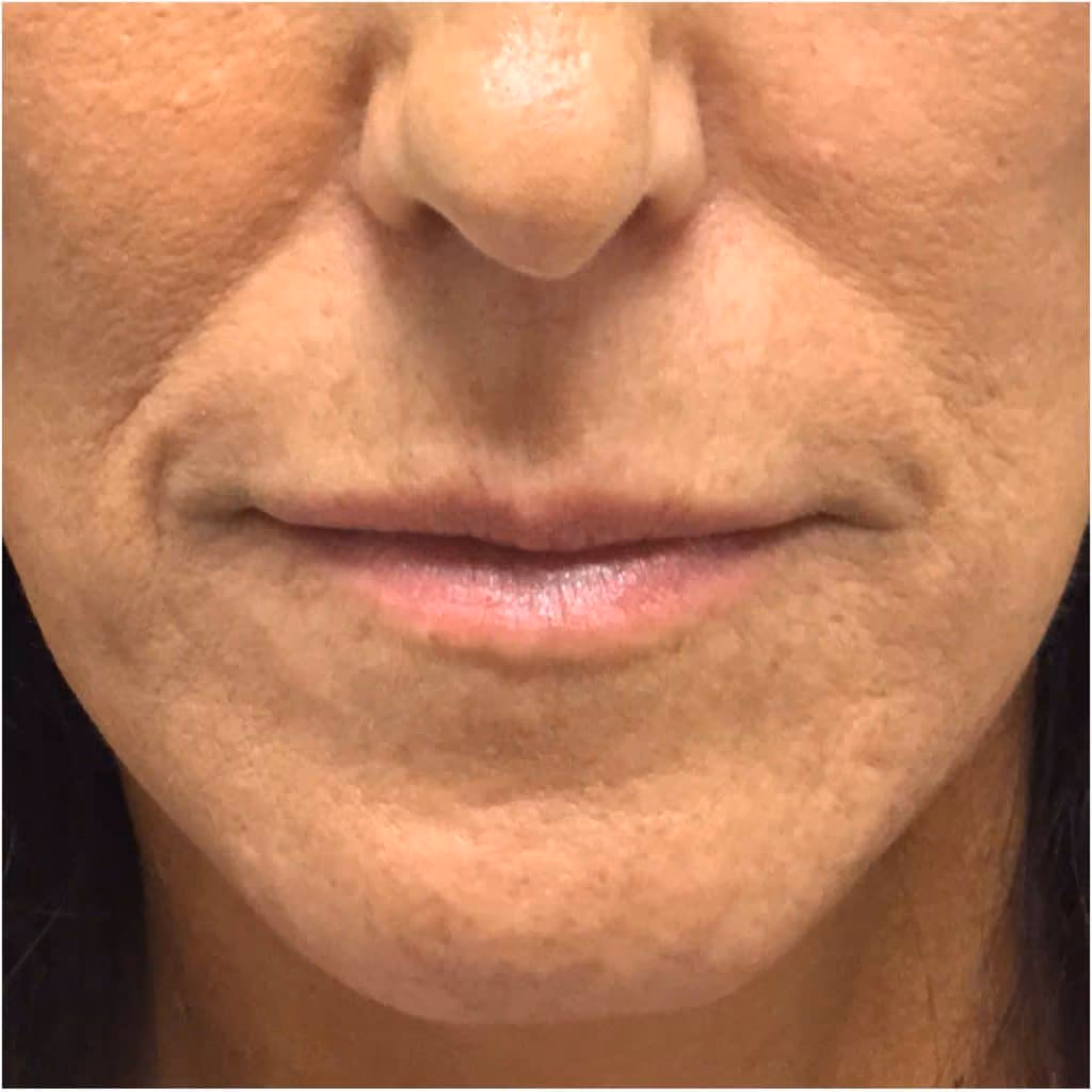 Filler before and after, case 11930 - Cool Springs Plastic Surgery