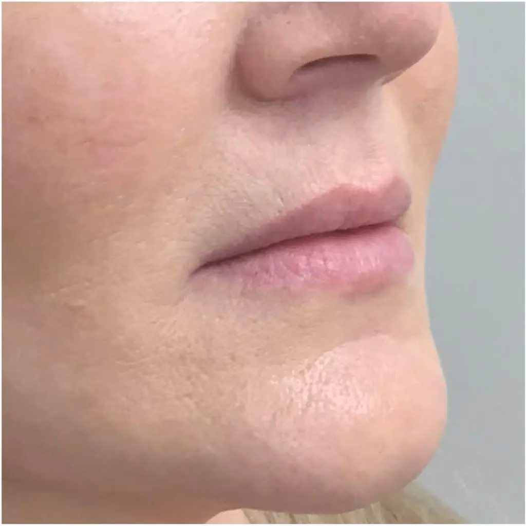 Filler before and after, case 11963 - Cool Springs Plastic Surgery