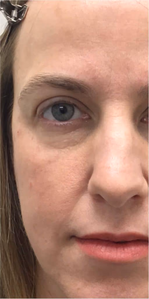 Filler before and after, case 11971 - Cool Springs Plastic Surgery