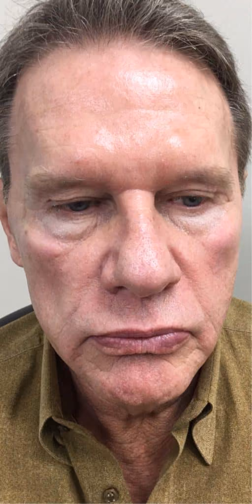 Filler before and after, case 11985 - Cool Springs Plastic Surgery