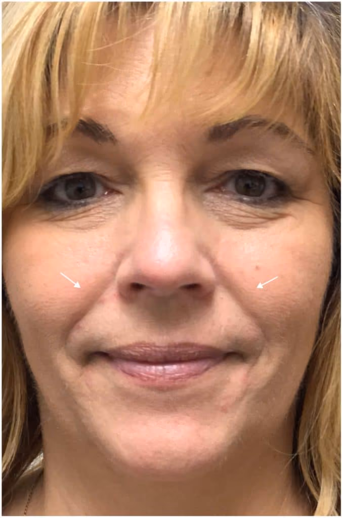 Filler before and after, case 12047 - Cool Springs Plastic Surgery