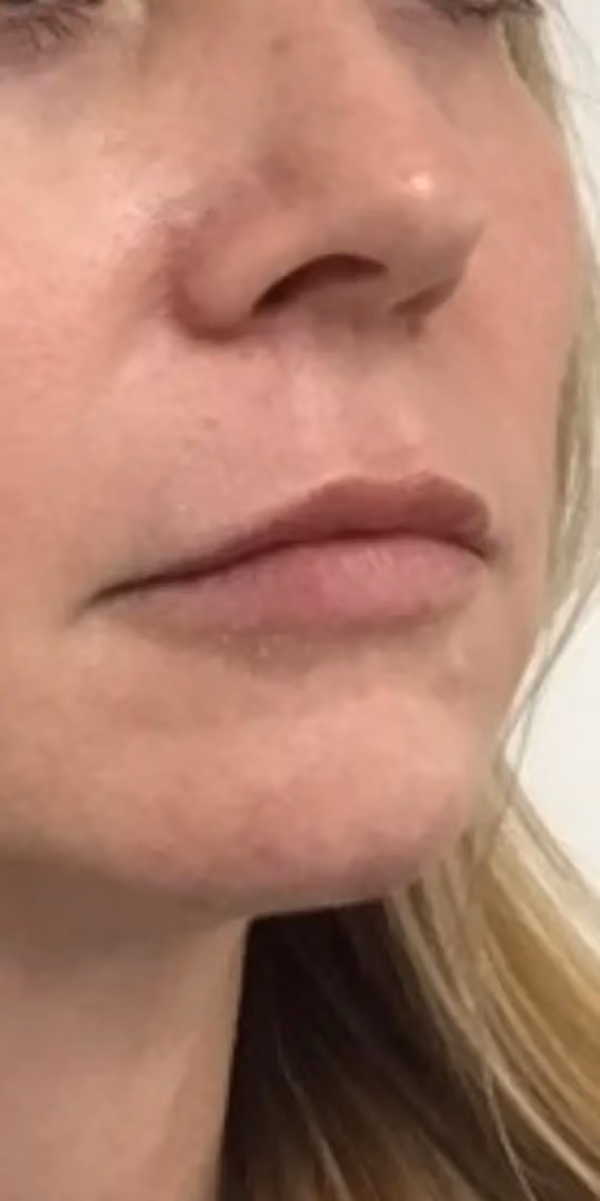 Filler before and after, case 12233 - Cool Springs Plastic Surgery