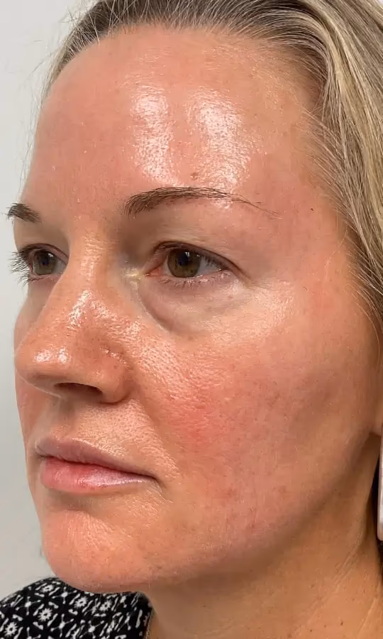 Filler before and after, case 12243 - Cool Springs Plastic Surgery