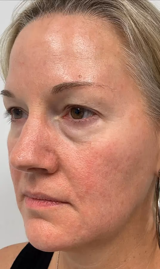 Filler before and after, case 12243 - Cool Springs Plastic Surgery