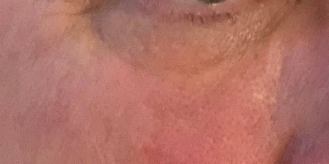 Filler before and after, case 12266 - Cool Springs Plastic Surgery