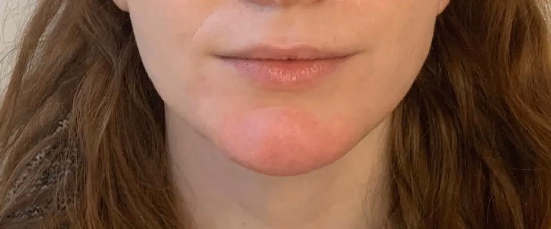 Filler before and after, case 12270 - Cool Springs Plastic Surgery