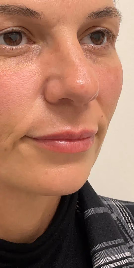 Filler before and after, case 12302-2 - Cool Springs Plastic Surgery