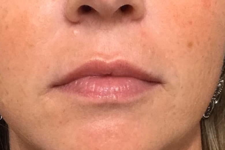 Filler before and after, case 14117 - Cool Springs Plastic Surgery