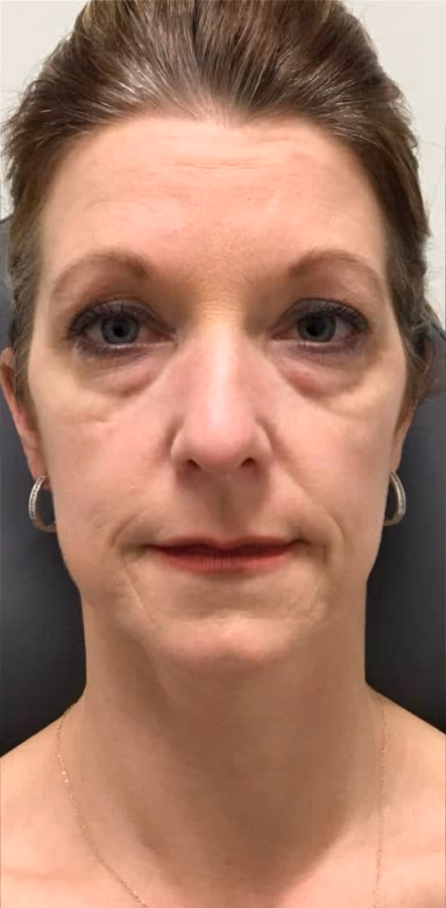 Filler before and after, case 14159 - Cool Springs Plastic Surgery