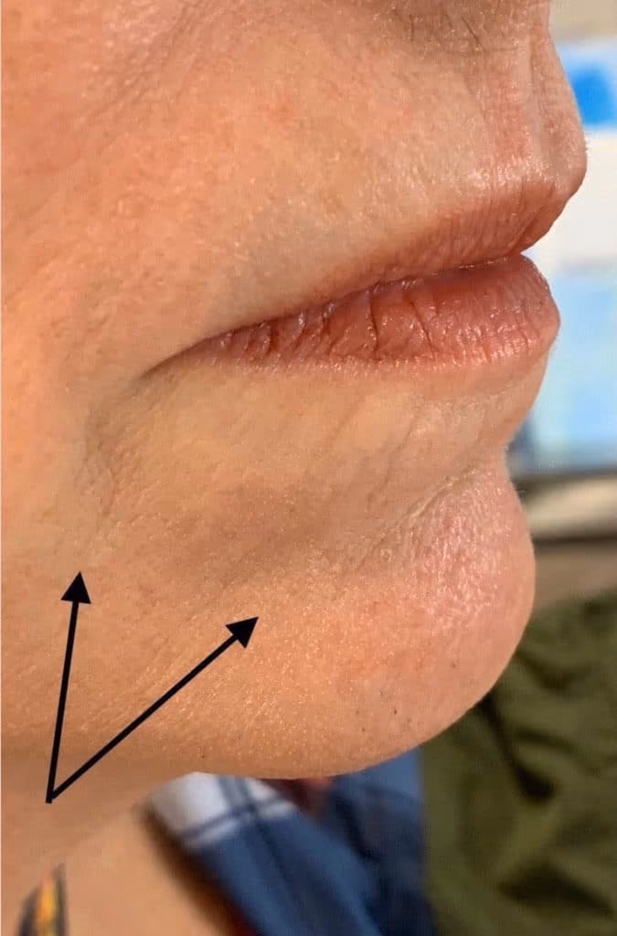 Filler before and after, case 14278 - Cool Springs Plastic Surgery