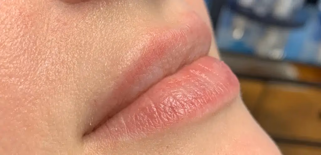 Filler before and after, case 14284 - Cool Springs Plastic Surgery