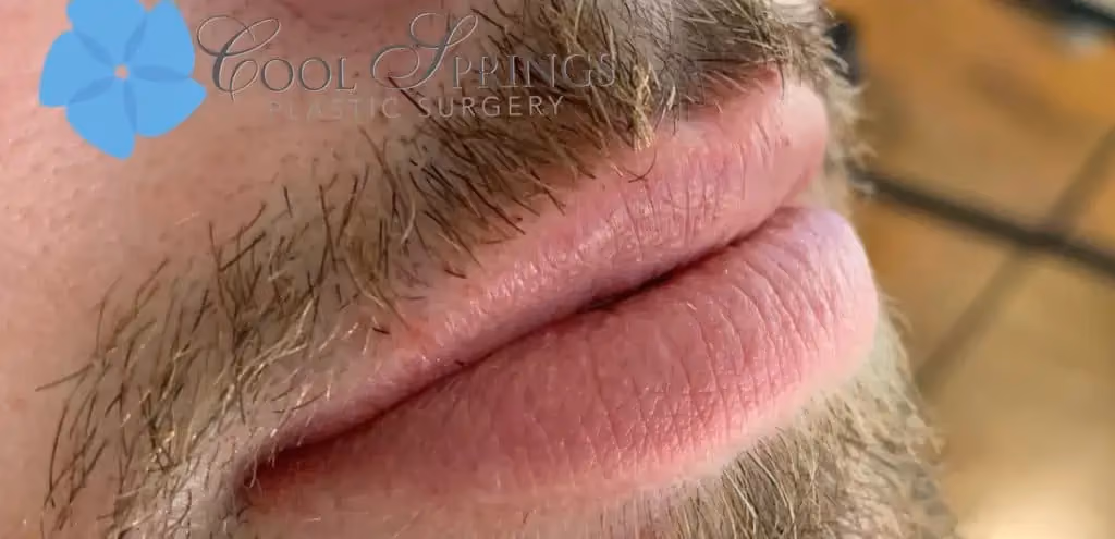 Filler before and after, case 14302 - Cool Springs Plastic Surgery