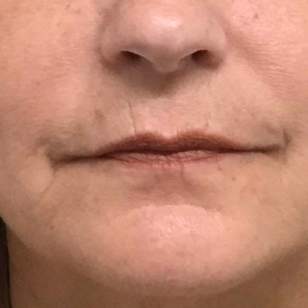 Filler before and after, case 14338 - Cool Springs Plastic Surgery