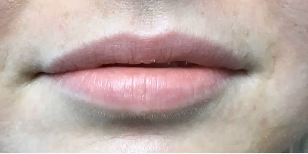 Filler before and after, case 14641 - Cool Springs Plastic Surgery