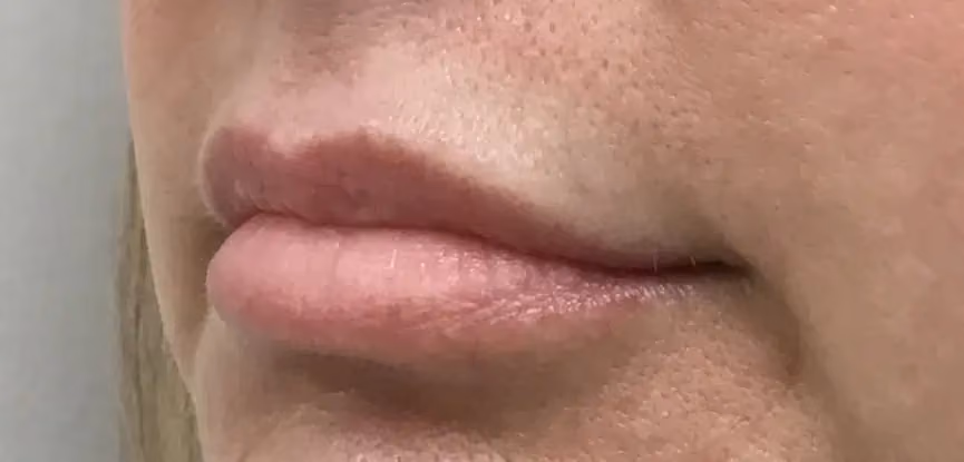 Filler before and after, case 14936 - Cool Springs Plastic Surgery