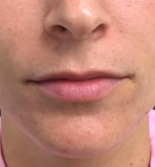 Filler before and after, case 15096 - Cool Springs Plastic Surgery