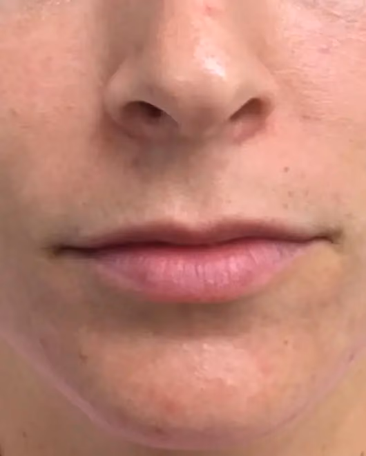 Filler before and after, case 15096 - Cool Springs Plastic Surgery