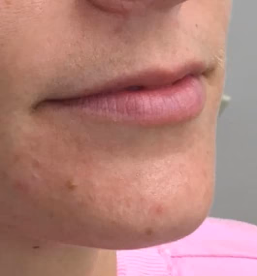 Filler before and after, case 15096 - Cool Springs Plastic Surgery