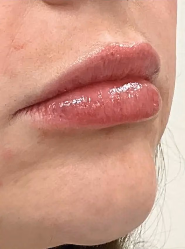 Filler before and after, case 15780-3 - Cool Springs Plastic Surgery