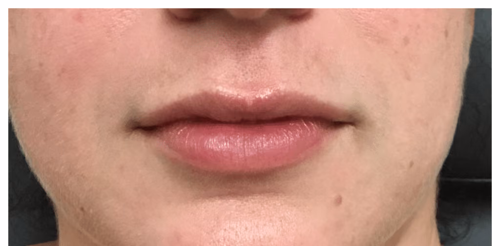 Filler before and after, case 15873 - Cool Springs Plastic Surgery