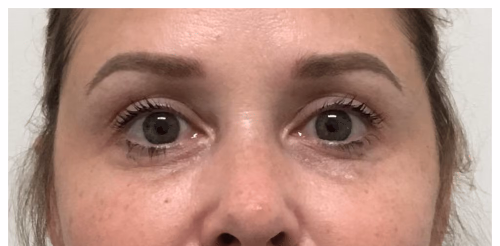 Filler before and after, case 15877 - Cool Springs Plastic Surgery
