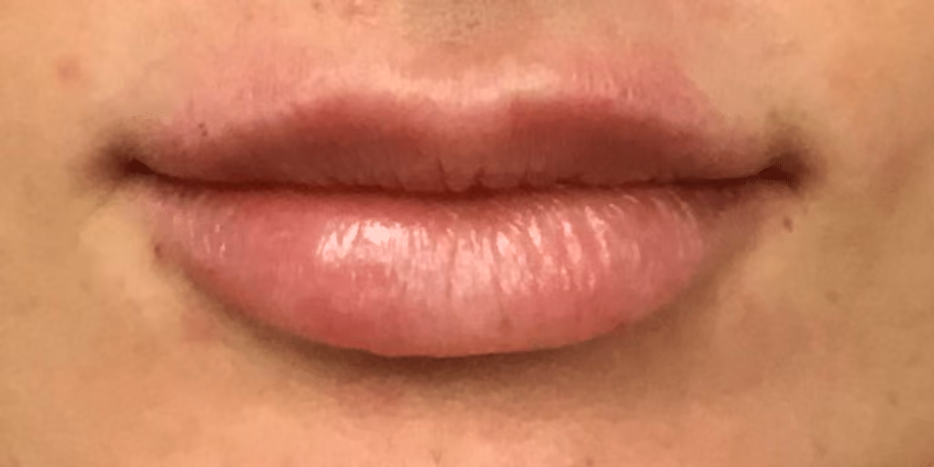 Filler before and after, case 15906 - Cool Springs Plastic Surgery