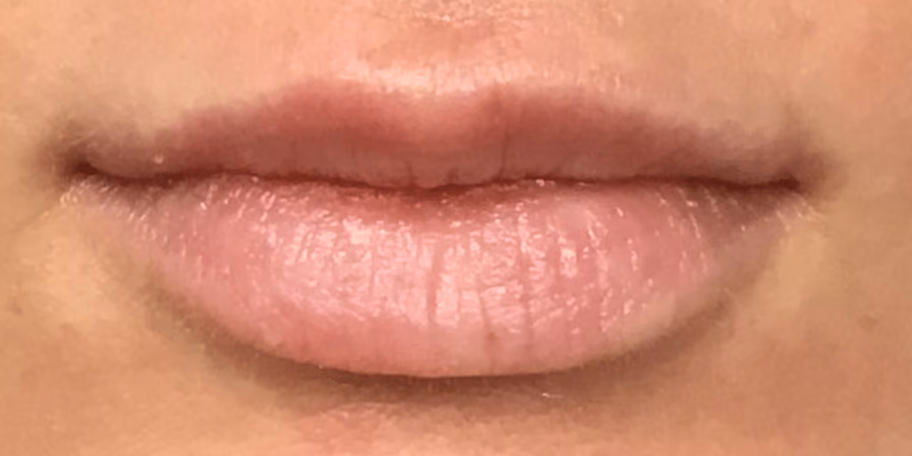 Filler before and after, case 15906 - Cool Springs Plastic Surgery