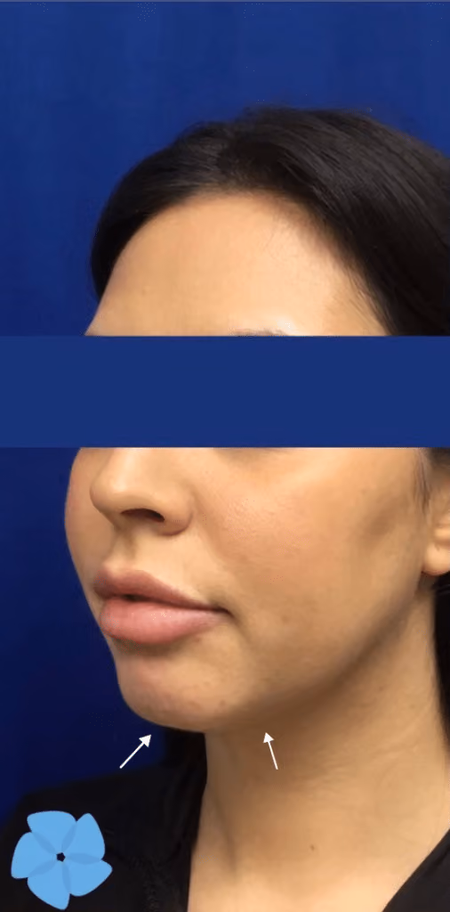 Filler before and after, case 15947 - Cool Springs Plastic Surgery
