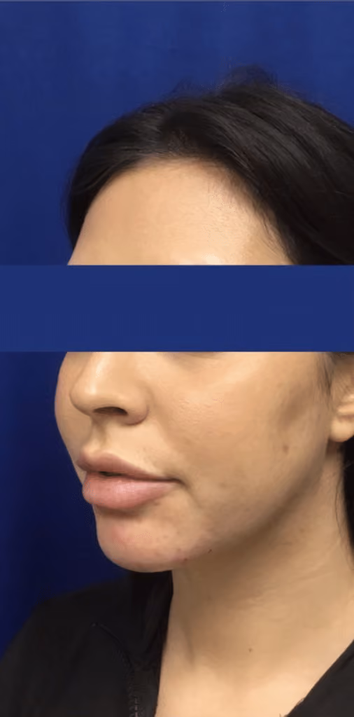 Filler before and after, case 15947 - Cool Springs Plastic Surgery