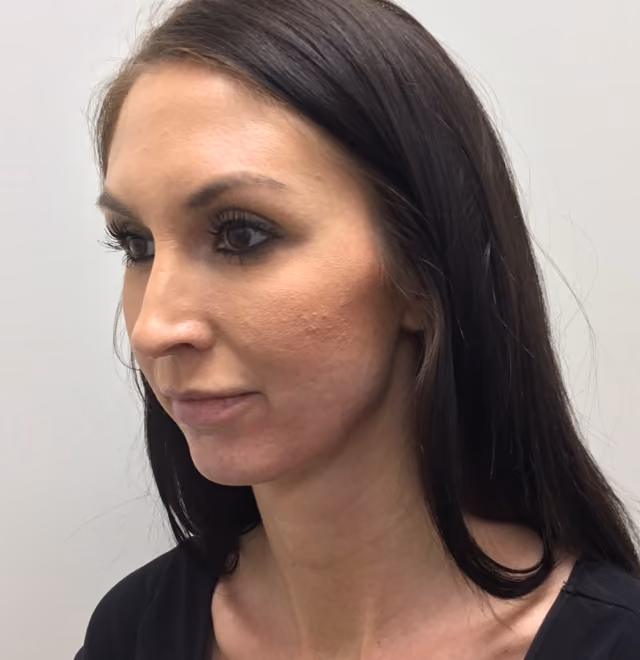 Filler before and after, case 16345 - Cool Springs Plastic Surgery