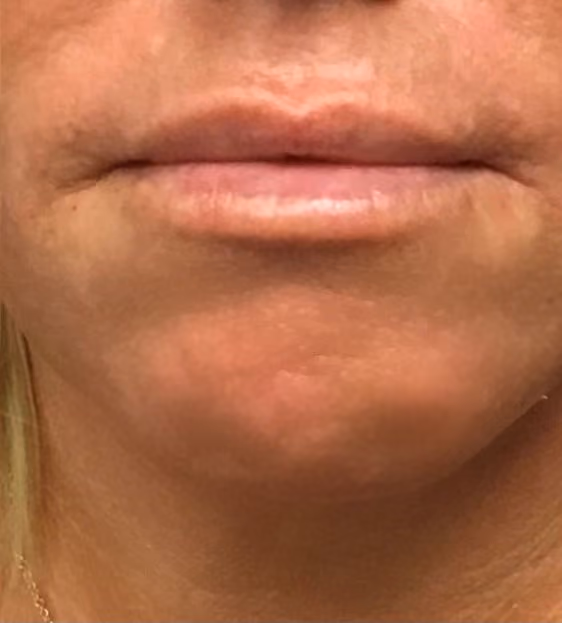 Filler before and after, case 16438 - Cool Springs Plastic Surgery