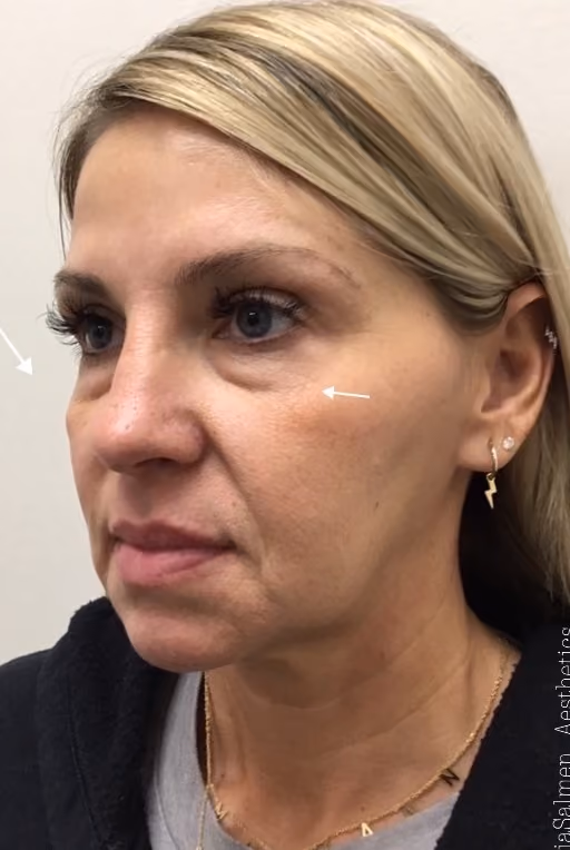 Filler before and after, case 17293 - Cool Springs Plastic Surgery