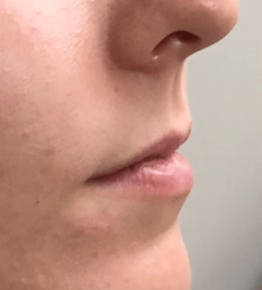 Filler before and after, case 17301 - Cool Springs Plastic Surgery